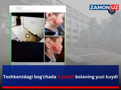 Toshkentdagi bogʻchada 3 yoshli bolaning yuzi kuydi