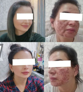 Toshkentdagi salonda ayolning yuzi kuydirib qo‘yildi